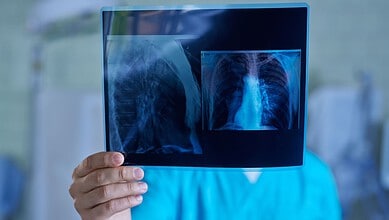 Medical professional examining lung X-ray for signs of lung cancer.