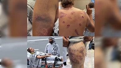 Image showing patients with extensive skin burns and bruises on their backs and legs in a medical setting.