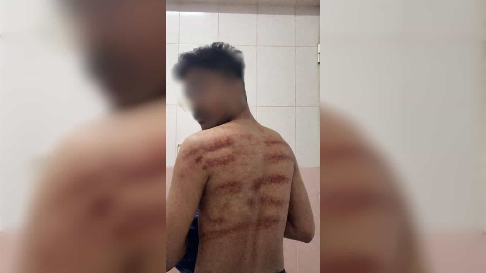 Young man with extensive back burns and scars, standing in a tiled room, facing away from the camera.
