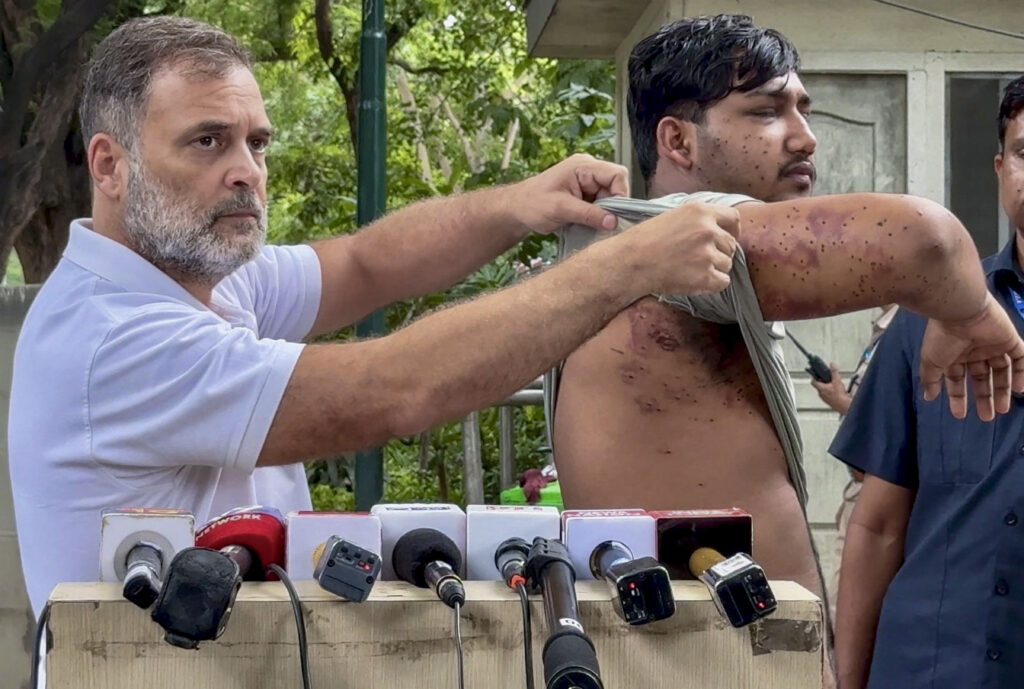 Man showing injuries on arm during press conference with microphones in front.
