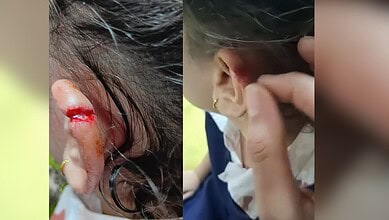 Child with injured ear and person examining ear in a close-up shot.