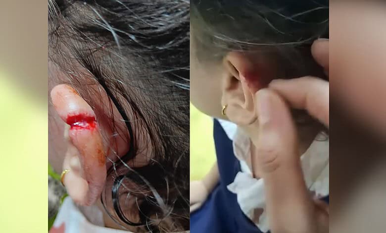 Child with injured ear and person examining ear in a close-up shot.