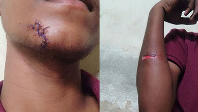 Close-up of a person's chin with stitches and arm with a fresh wound.