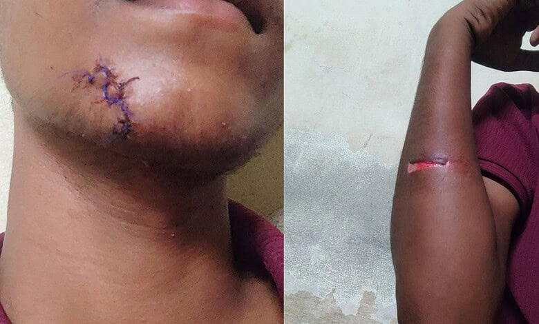 Close-up of a person's chin with stitches and arm with a fresh wound.