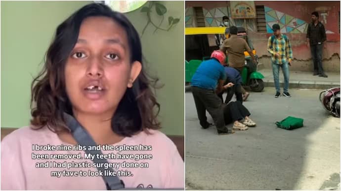 Bengaluru woman speaks about her near-fatal accident and lack of support from Rapido.