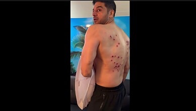Man with multiple red spots on his back, looking over shoulder indoors.