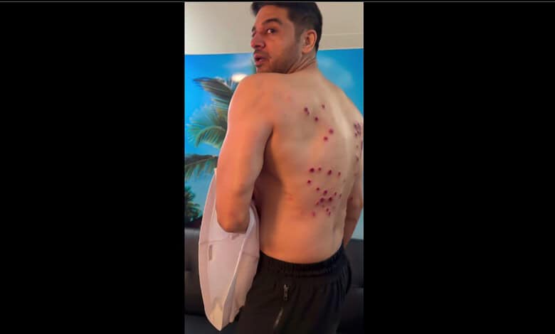 Man with multiple red spots on his back, looking over shoulder indoors.