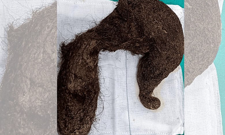 20-yr-old ate hair, Delhi doctors remove 1.16-kg hairball